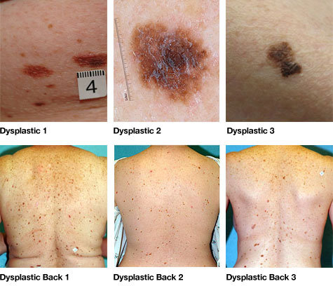 Irregular Moles Chart