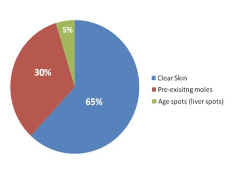 where-melanomas-start-source-of-,elanomas-on-the-skin