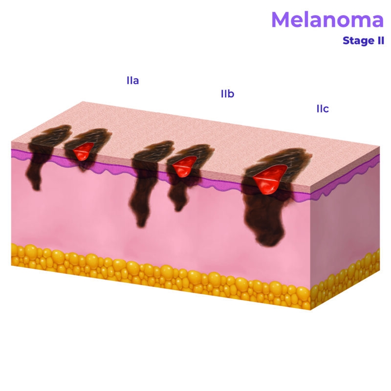 Ultraviolet (UV) Radiation - AIM at Melanoma Foundation