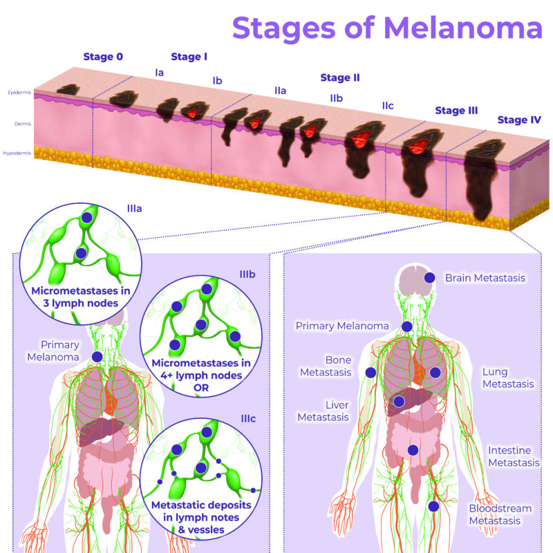 Melanoma Skin Cancer Diagram