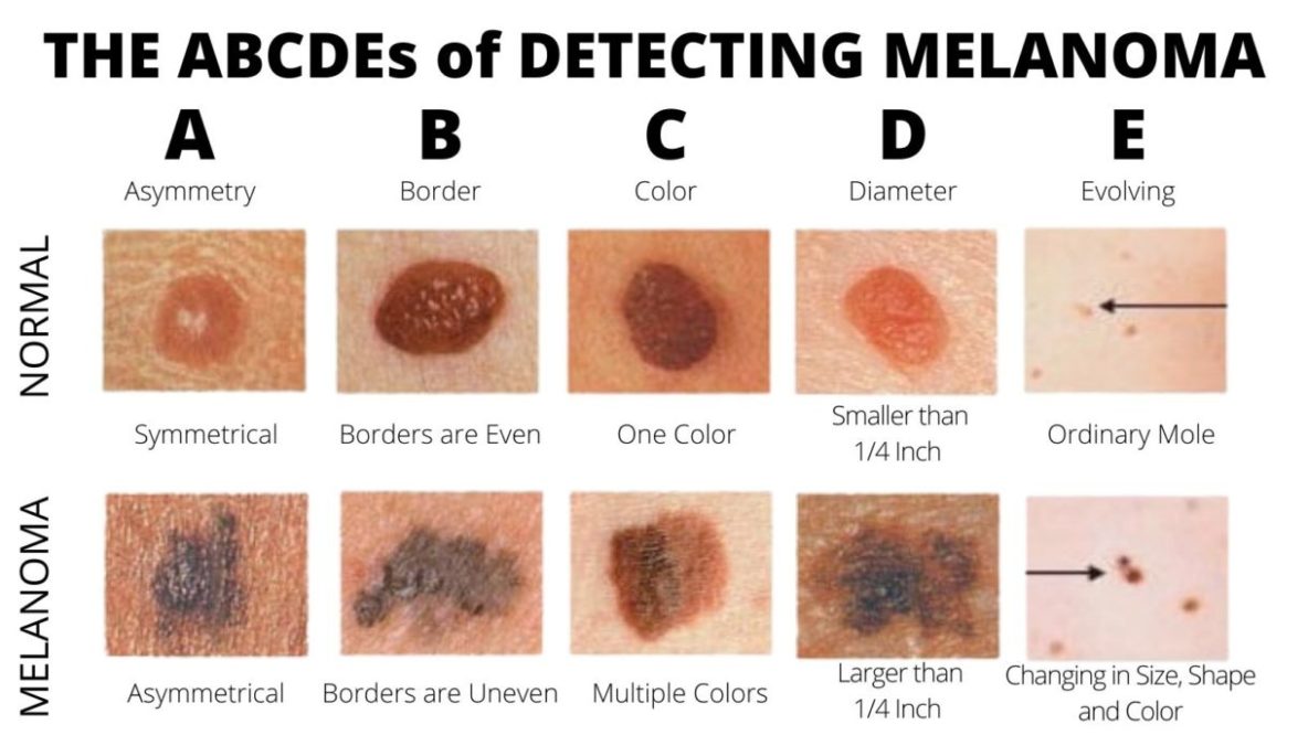 moles-aim-at-melanoma-foundation