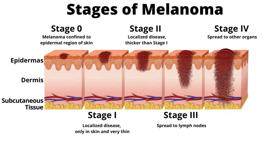 Stages of melanoma aim at melanoma foundation
