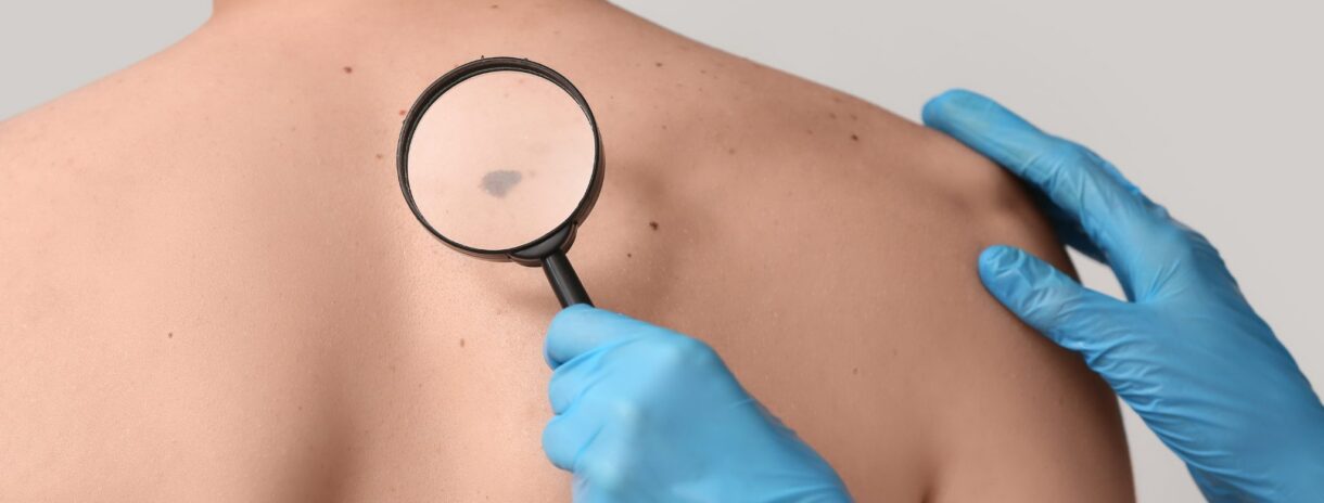 Featured image for “What Does Melanoma Look Like?”