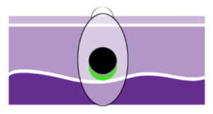 Stage II b