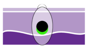Stage II c