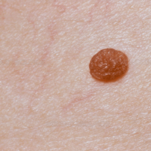 benign nevus