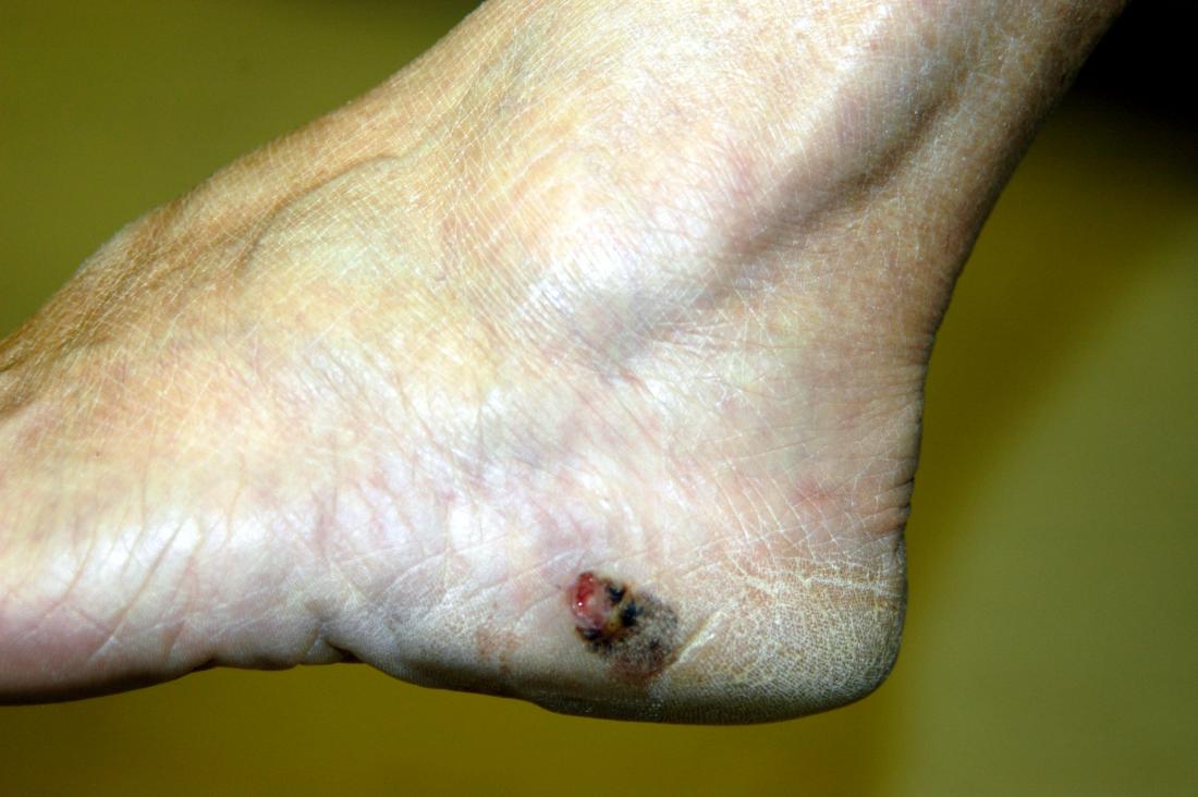 acral-lentiginous-melanoma-aim-at-melanoma-foundation