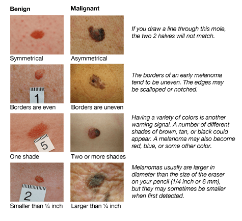 How to Tell a Mole from Melanoma - AIM at Melanoma Foundation