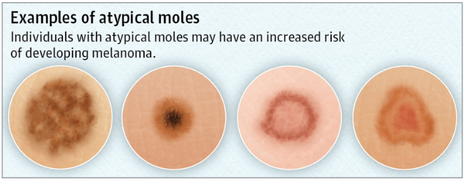 Examples mole