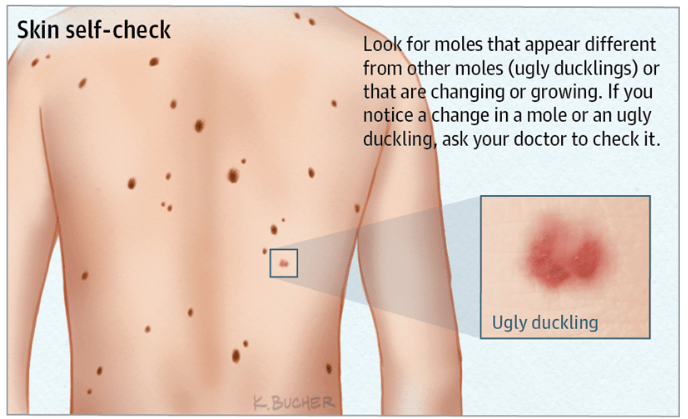 Example mole