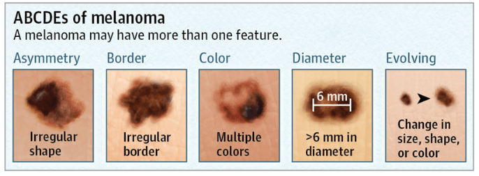 cancerous moles vs normal moles