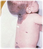 Un enfant de 4 mois avec un naevus congenital geant.