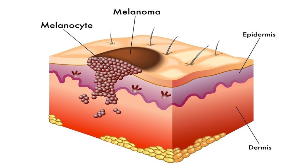 Understanding Melanoma - AIM at Melanoma Foundation