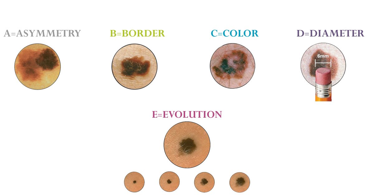 cancerous moles vs normal moles