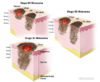 Understanding Melanoma: Treatment Options for Stage II Melanoma