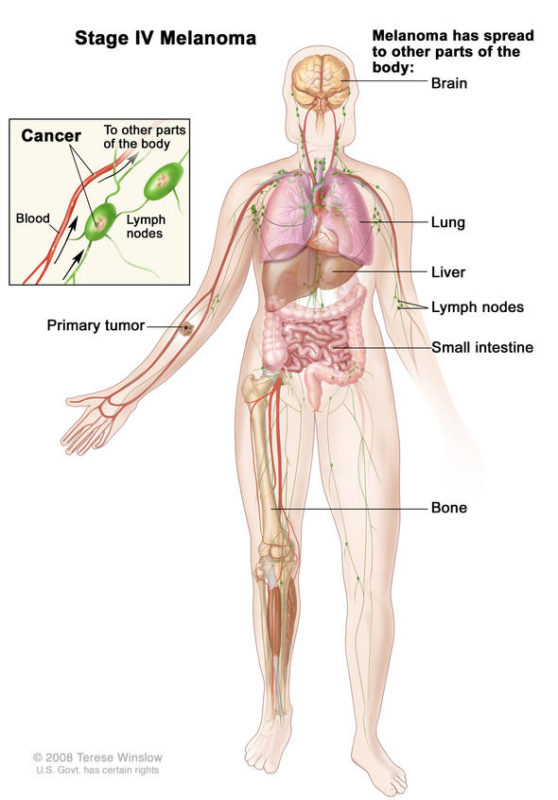 Stage Metastatic Melanoma