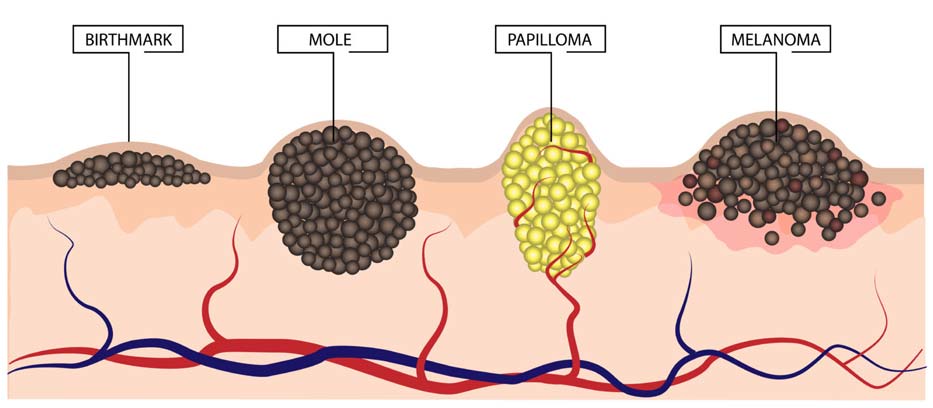 cancerous moles vs normal moles