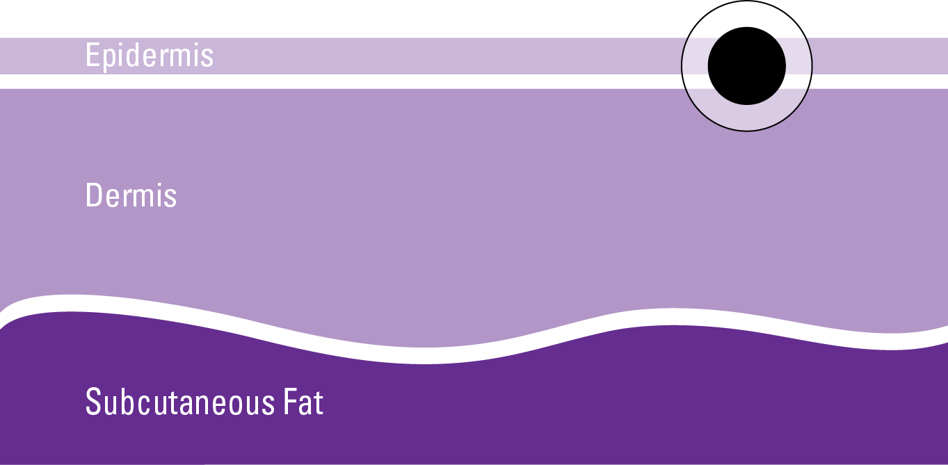 stages-of-melanoma-1