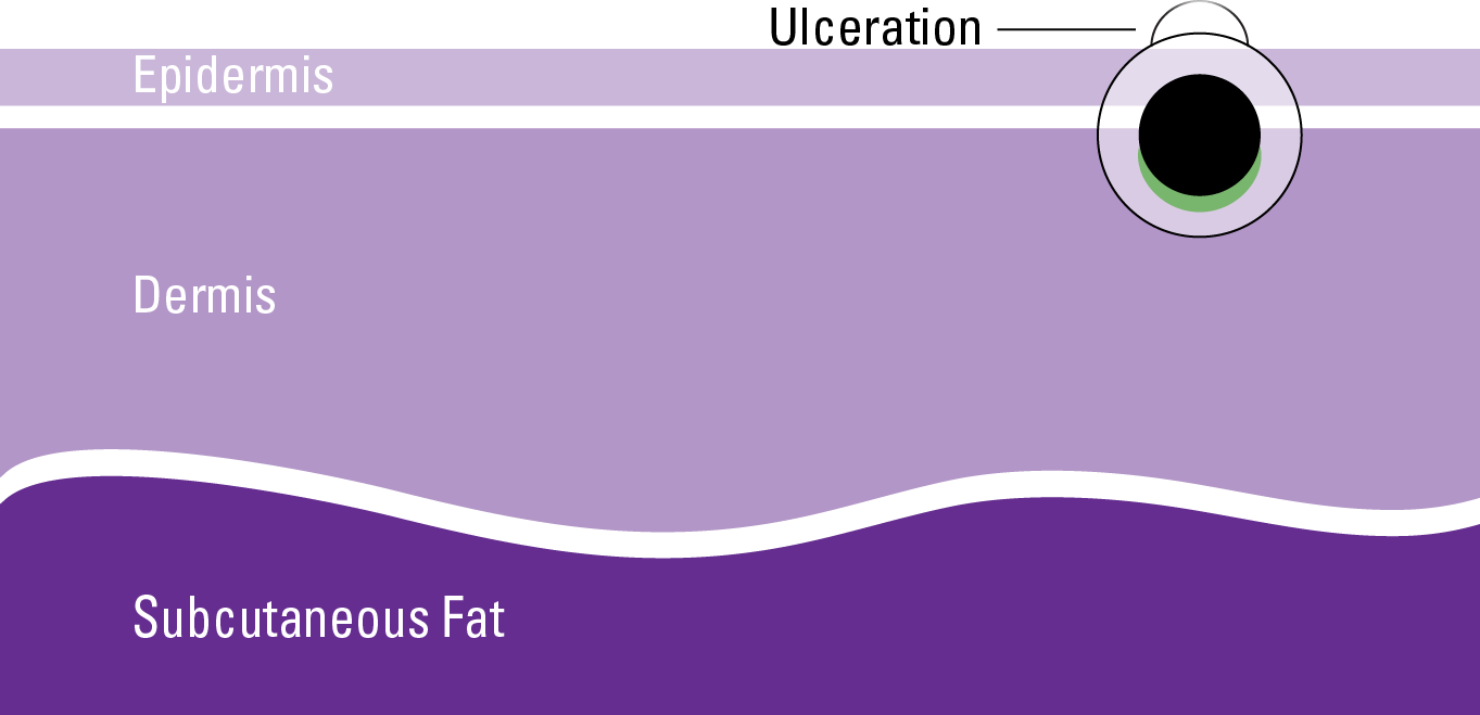 stages-of-melanoma-2