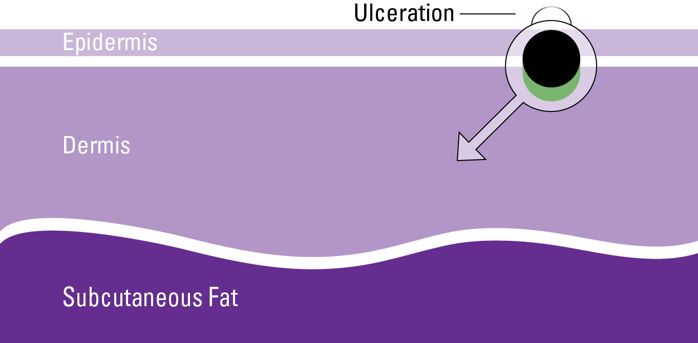 stages-of-melanoma-3