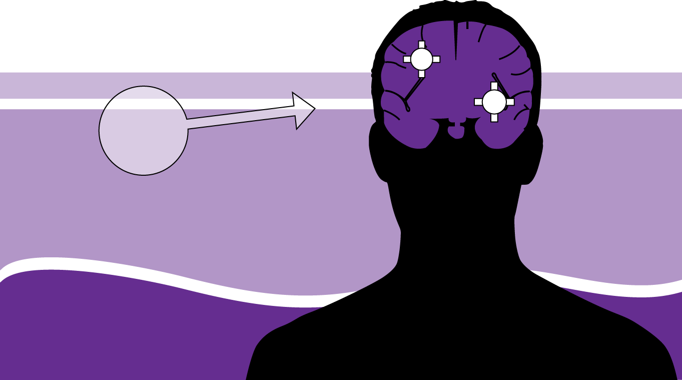 Blocking Inflammatory Pathway Key to Preventing Brain Metastasis from Melanoma Blocking Inflammatory Pathway Key to Preventing Brain Metastasis from Melanoma